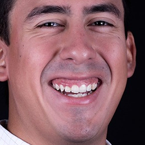 Recorte de encía después - Marcelo