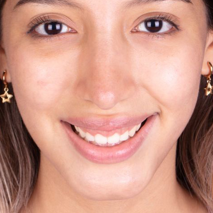 Recorte de encía después - joven