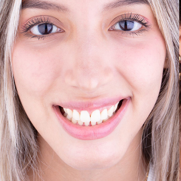 Recorte de encía antes - joven